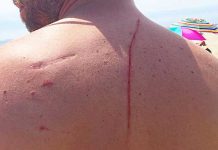 shark attack saved his life