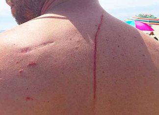 shark attack saved his life