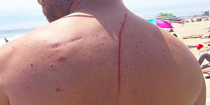 shark attack saved his life