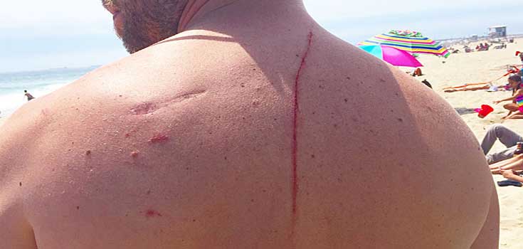 shark attack saved his life