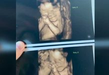 extremely rare twins birth