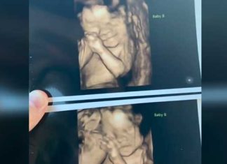 extremely rare twins birth